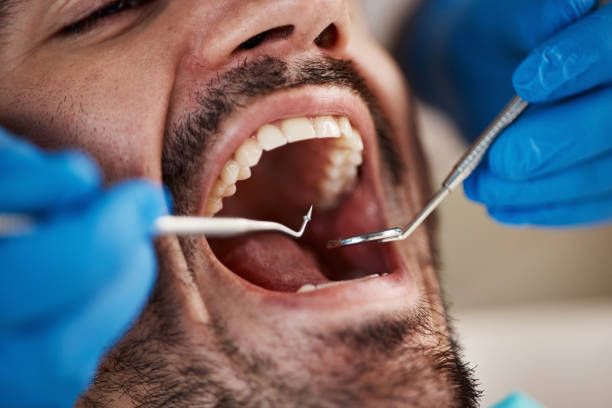 Dental Bonding in Vaughn, WA